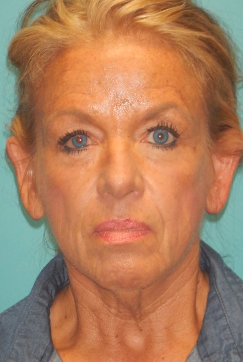 Before Image: Neck Lift: Case 9 - front
