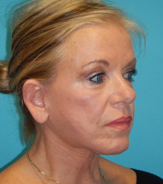 After Image: Neck Lift: Case 9 - right-front-oblique