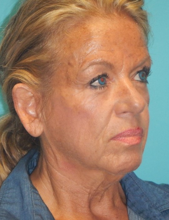 Before Image: Neck Lift: Case 9 - right-front-oblique