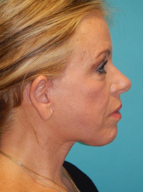After Image: Neck Lift: Case 9 - right-side