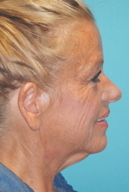 Before Image: Neck Lift: Case 9 - right-side