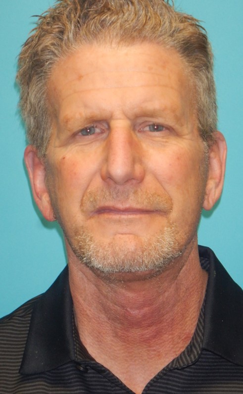 After Image: Neck Lift: Case 10 - front