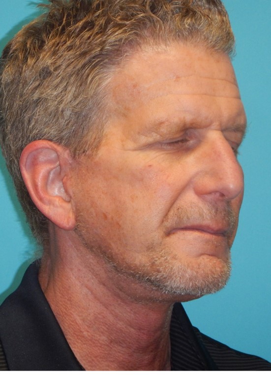 After Image: Neck Lift: Case 10 - right-front-oblique
