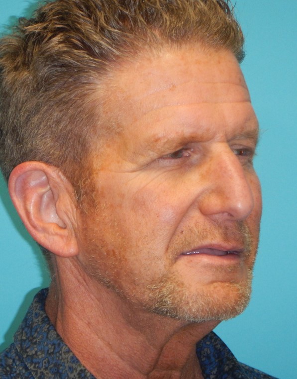 Before Image: Neck Lift: Case 10 - right-front-oblique