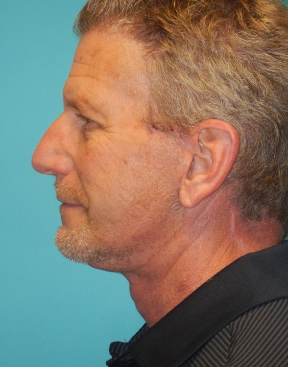 After Image: Neck Lift: Case 10 - left-side