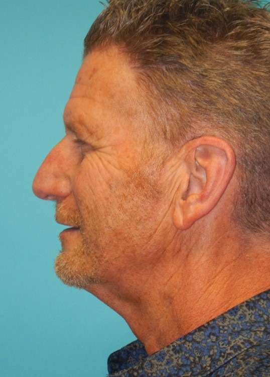 Before Image: Neck Lift: Case 10 - left-side