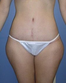 After Image: Outer Thigh Lift: Case 8 - front