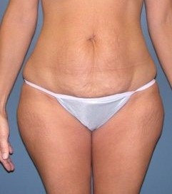 Before Image: Outer Thigh Lift: Case 8 - front