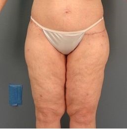 After Image: Outer Thigh Lift: Case 9 - front
