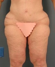 Before Image: Outer Thigh Lift: Case 9 - front