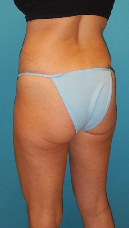 Before Image: BBL: Case 10 - left-back-oblique