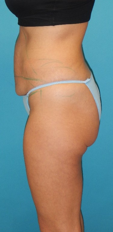 Before Image: BBL: Case 10 - left-side
