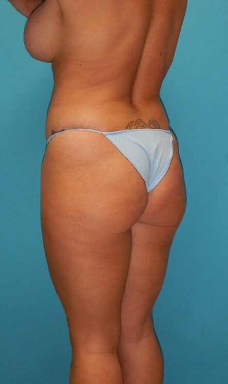 Before Image: BBL: Case 12 - left-back-oblique