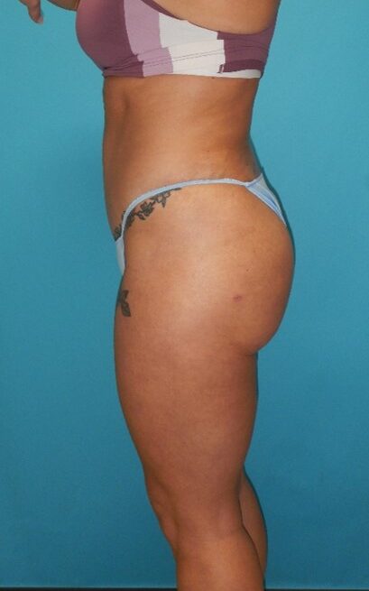 After Image: BBL: Case 12 - left-side
