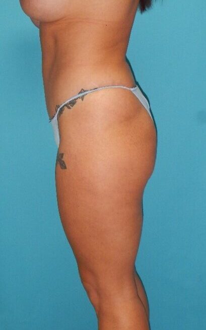 Before Image: BBL: Case 12 - left-side