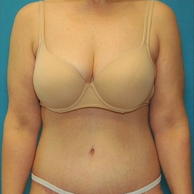 original_after After Tummy Tuck