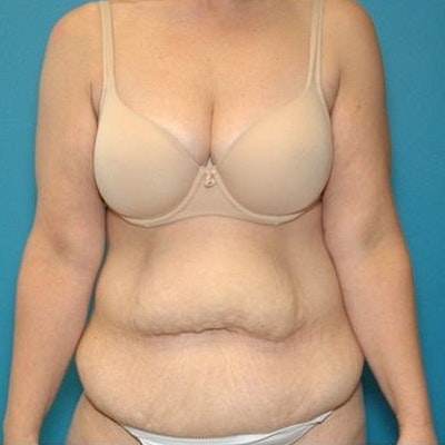 original_before Before Tummy Tuck